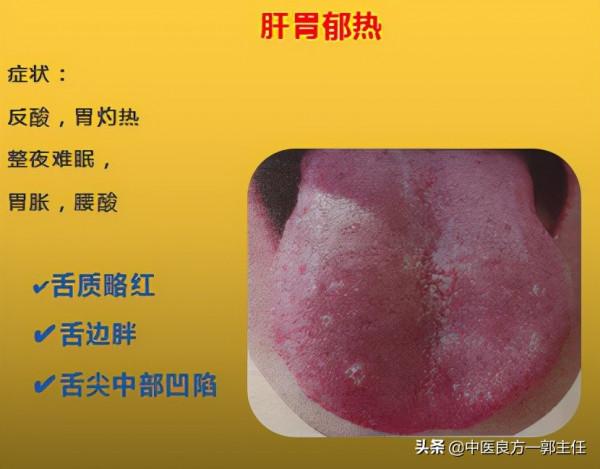 12種“熱”藏於體內,反應的舌象、症狀各不相同,自查便知 12種“熱”藏於體內,反應的舌象、症狀各不相同,自查便知
