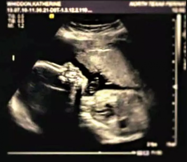 B超嬰兒無四肢,18歲媽媽拒絕墮胎,冒險生子,把孩子養成男子漢 B超嬰兒無四肢,18歲媽媽拒絕墮胎,冒險生子,把孩子養成男子漢