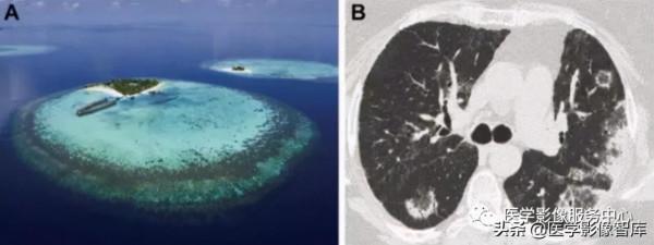 22個肺部疾病的CT徵象 22個肺部疾病的CT徵象