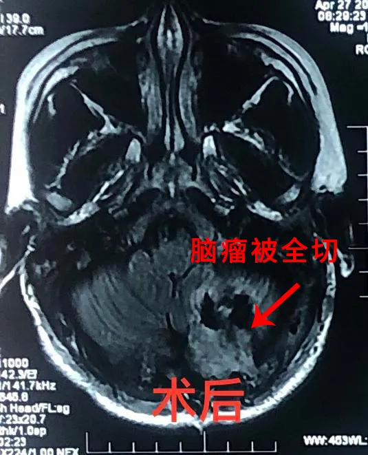 12歲男孩腦瘤3個月瘋長3倍 看專家如何成功&OpenCurlyDoubleQuote;拆彈&rdquo;