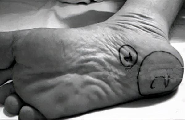 足跟痛——從原理到治療 足跟痛——從原理到治療