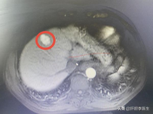 肝癌從3釐米長到6釐米需要多久? 肝癌從3釐米長到6釐米需要多久?