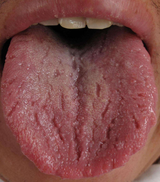 中醫舌診：舌頭為什麼會出現裂紋？分四種原因