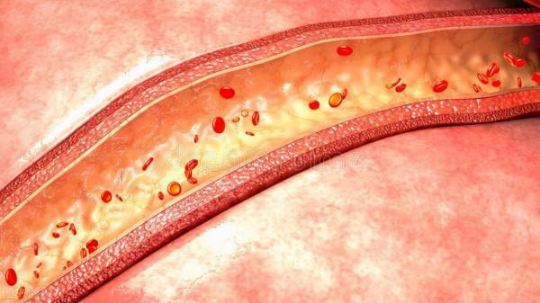 56歲大叔，每天吃洋蔥降血脂，一個月後他的血脂有啥變化？