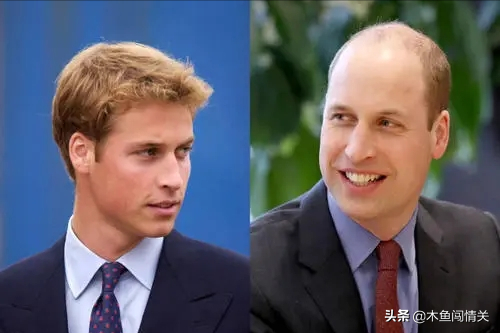 戴安娜嫁查爾斯,都改變不了威廉變禿的命運 戴安娜嫁查爾斯,都改變不了威廉變禿的命運