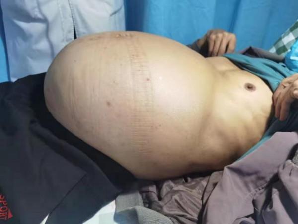 35斤巨瘤藏身腹部,耗時5小時剝出“西瓜大”腹膜後腫瘤 35斤巨瘤藏身腹部,耗時5小時剝出“西瓜大”腹膜後腫瘤