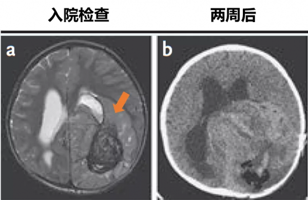 為什麼這個3歲孩子的腦腫瘤消失了？