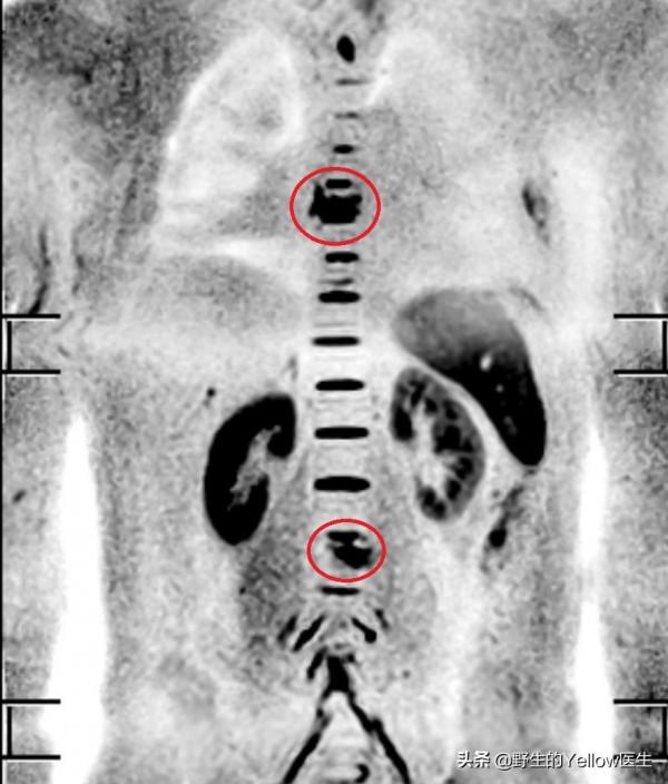 健身預防癌症嗎? 健身預防癌症嗎?
