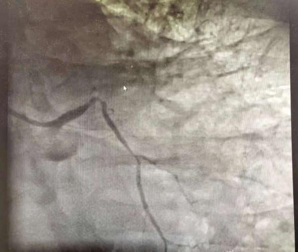 50歲急性心梗，植入支架也沒能救命！醫生嘆息：這些併發症更要命