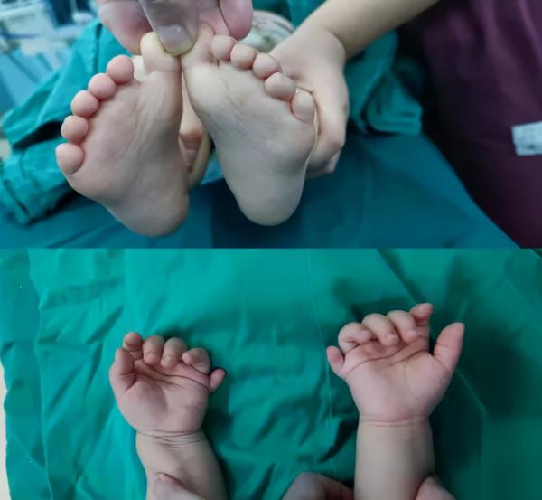 寶寶雙手雙足多指、趾畸形,醫生巧施手術成功“去指” 寶寶雙手雙足多指、趾畸形,醫生巧施手術成功“去指”