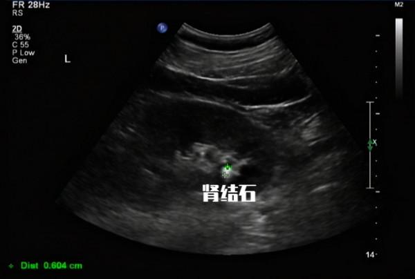 尿隱血3+但尿紅細胞正常，是腎炎？還是尿常規結果出問題了嗎？