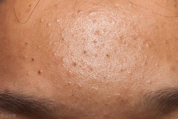 臉上長閉口性粉刺是什麼原因