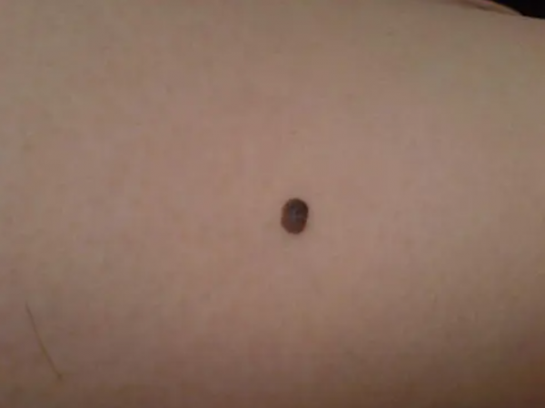 身體5個地方長“黑痣”，或許是腸息肉的“暗示”，要引起警惕