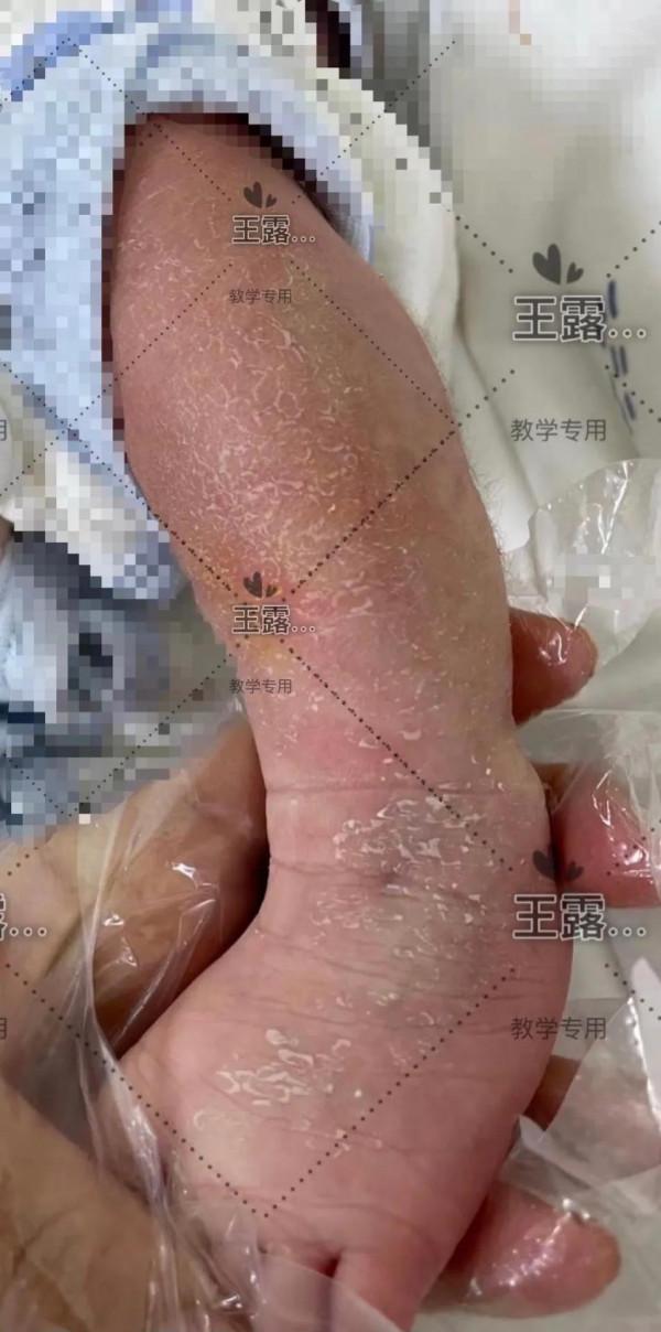 新生兒一過性面板病（上）