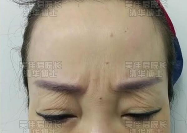 額頭提升後的她們，沒了抬頭紋、川字紋，眼睛也更有神了