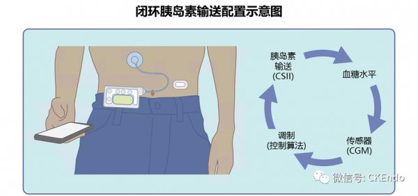 臨床內分泌未來篇 &vert; 2021新閉環胰島素系統-感測器、胰島素泵和控制系統