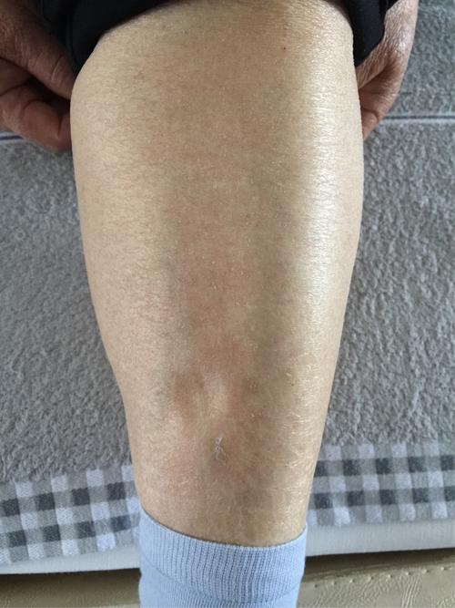 有泡沫尿就是腎臟出現問題了嗎?醫生坦言:這可不一定 有泡沫尿就是腎臟出現問題了嗎?醫生坦言:這可不一定