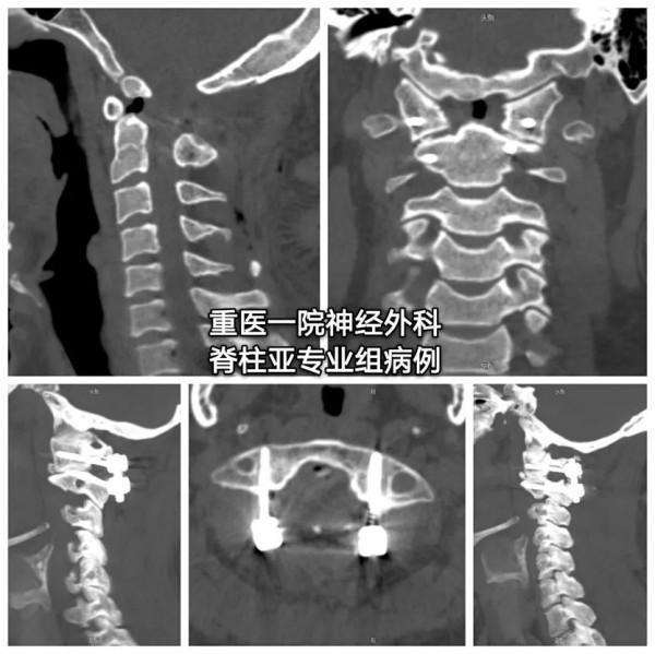 C2椎動脈高跨置釘技術之N
