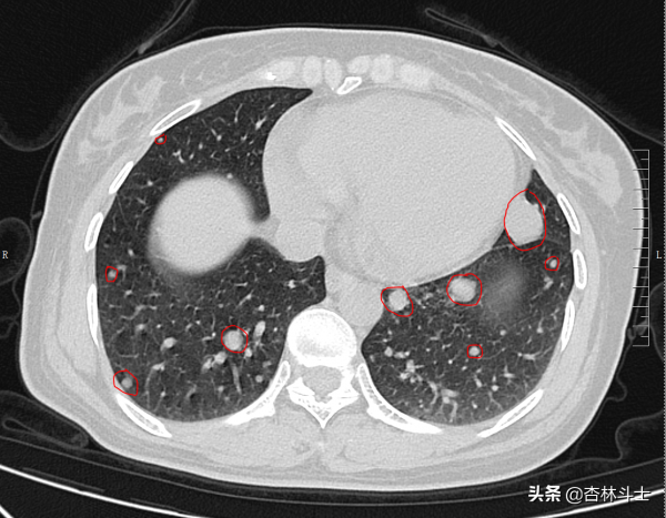中年女性，兩年連續多次預警不重視，再次檢查發現腫瘤已是晚期了