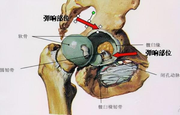 生命彙整合國際醫療提醒:髖關節彈響需要被重視嗎? 生命彙整合國際醫療提醒:髖關節彈響需要被重視嗎?