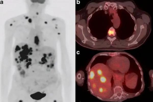 癌細胞&OpenCurlyDoubleQuote;喜歡&rdquo;吃糖還是蛋白質？或許對此你並不瞭解，現在告訴你