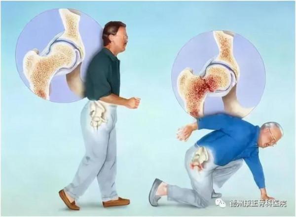 股骨頸骨折以後的我到底有多消極？