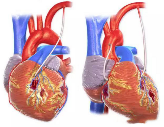 全國科普日：醫生靠什麼評估冠心病