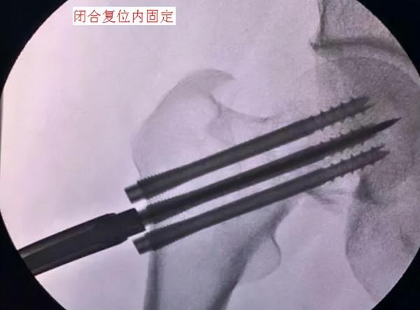 股骨頸骨折後的治療方案