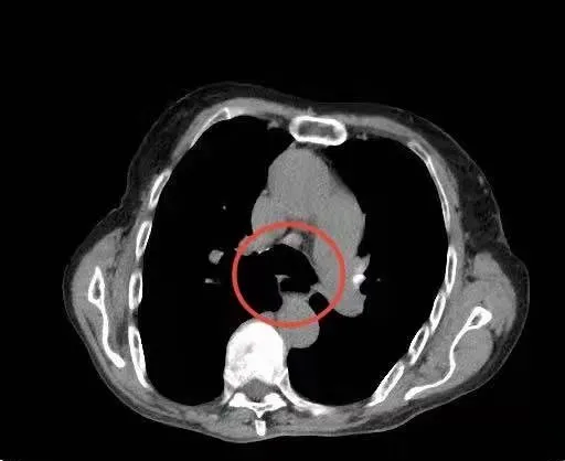 82歲老人半個月不能進食以為是食管癌，結果是肉堵食道