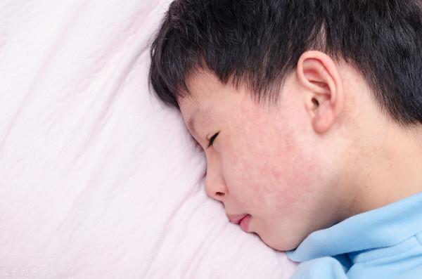 麻疹是什麼?打麻疹疫苗可以終身免疫嗎? 麻疹是什麼?打麻疹疫苗可以終身免疫嗎?
