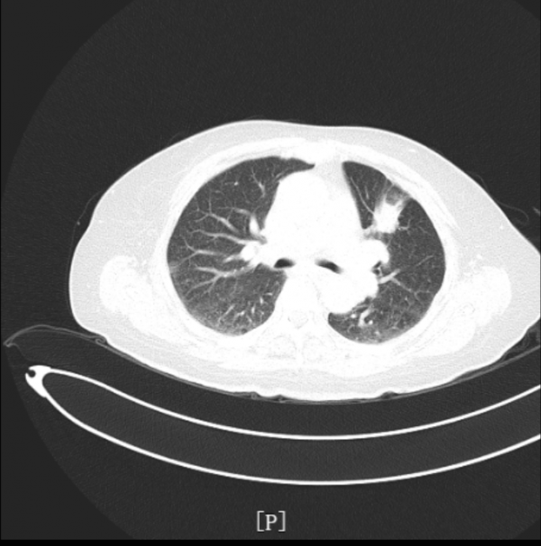 百例徵優 | 貝伐珠單抗聯合化療——為晚期肺癌多發轉移患者帶來新希望