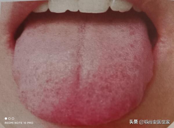 咳嗽、風熱犯肺的舌象