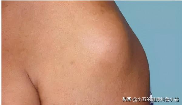 什麼是脂肪瘤，它會癌變嗎，我們應該怎麼正確治療脂肪瘤