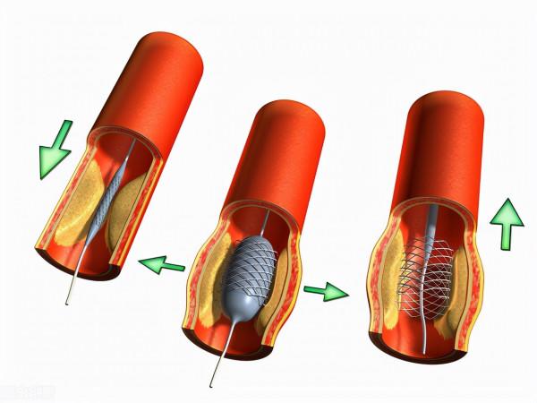 可以導致猝死的“心梗”，致命的危險是怎樣發生的？