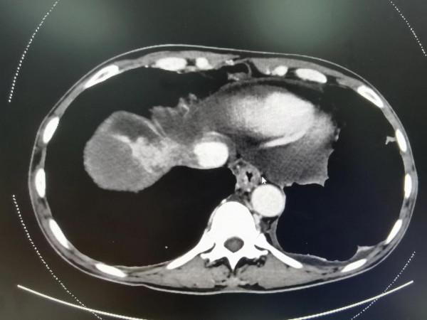 晚期肝癌的介入治療
