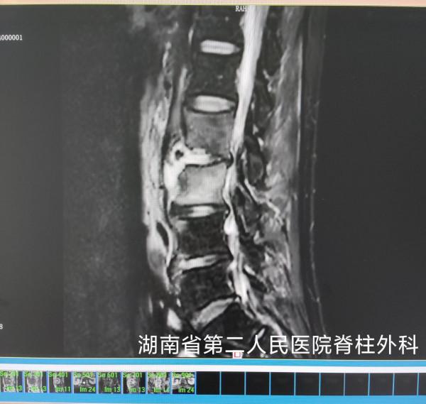 大叔腿痛半年多、腰痛2月,竟是因為這種真菌感染了脊柱 大叔腿痛半年多、腰痛2月,竟是因為這種真菌感染了脊柱