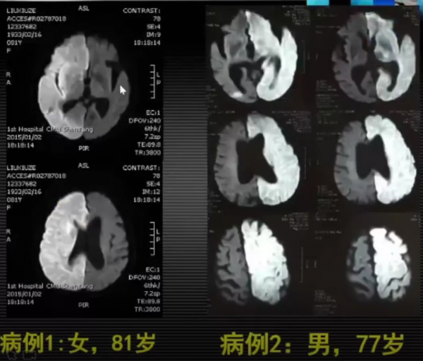 急性腦梗死MRI的臨床特點，超強解讀