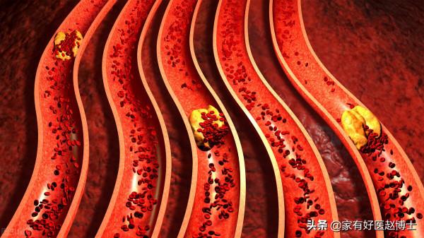 “血管老化”的五大常見徵象,您有嗎?及時干預,哪些藥物可選? “血管老化”的五大常見徵象,您有嗎?及時干預,哪些藥物可選?