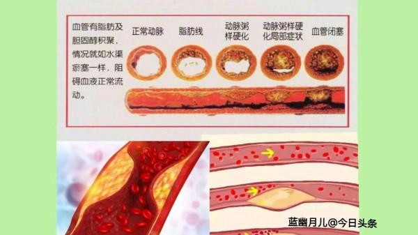 腔隙性腦梗死的診療常規
