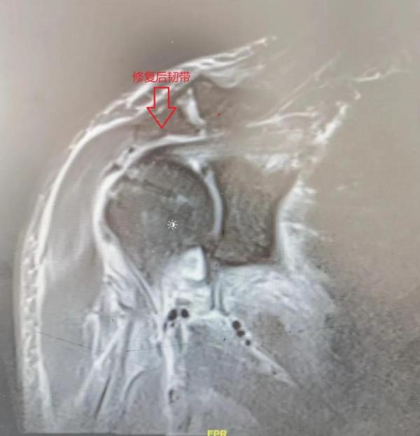 南昌大學二附院系列科普：肩袖損傷
