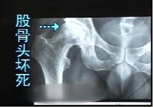 得了股骨頭壞死要多吃什麼食物好？