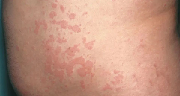 中西醫結合治療蕁麻疹怎麼樣？