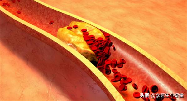 老年人預防腦梗，補充葉酸很重要，如何補才正確？總結3個要點