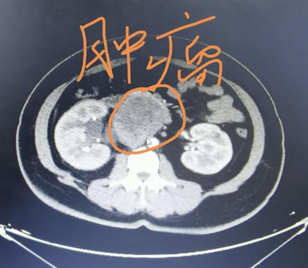 劉懿博士說肺癌(三〇二五)兩年沒體檢,42歲教師腹部肺部有問題 劉懿博士說肺癌(三〇二五)兩年沒體檢,42歲教師腹部肺部有問題