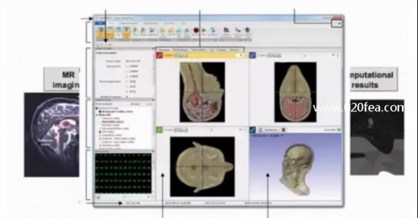 人體組織三維建模技術與有限元分析 人體組織三維建模技術與有限元分析