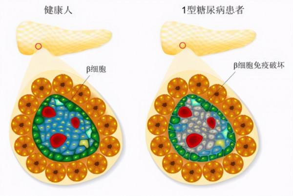 糖尿病疫苗要來了?每月打一針就能降糖? 糖尿病疫苗要來了?每月打一針就能降糖?
