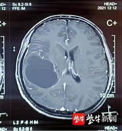 微創手術，切除腦中7釐米瘤