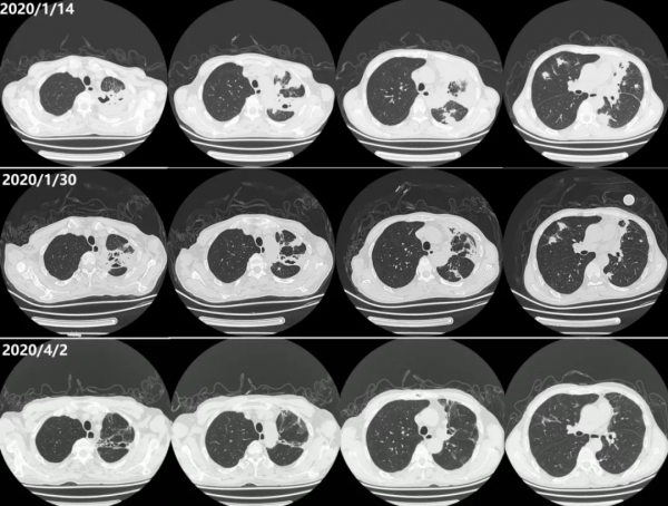 中年男性反覆發熱、咳嗽、咳痰,肺部陰影緣何而生? 中年男性反覆發熱、咳嗽、咳痰,肺部陰影緣何而生?