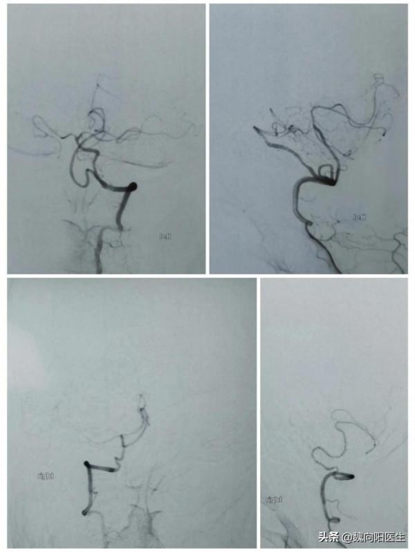 奔著做支架來醫院，最後發現是血管變異引起，避免了一場大手術