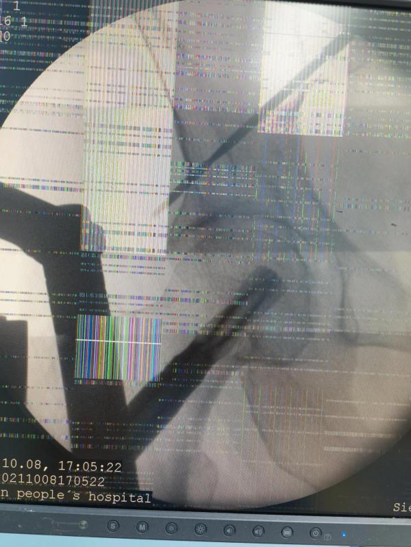 股骨轉子間骨折一例